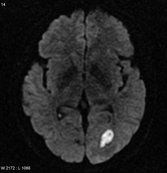 File:Cerebral abscess - shaggy borders (Radiopaedia 5492-7225 Axial DWI 1).jpg