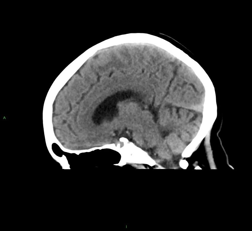 Cerebral amyloid angiopathy-associated lobar intracerebral hemorrhage (Radiopaedia 58378-65516 C 28).jpg