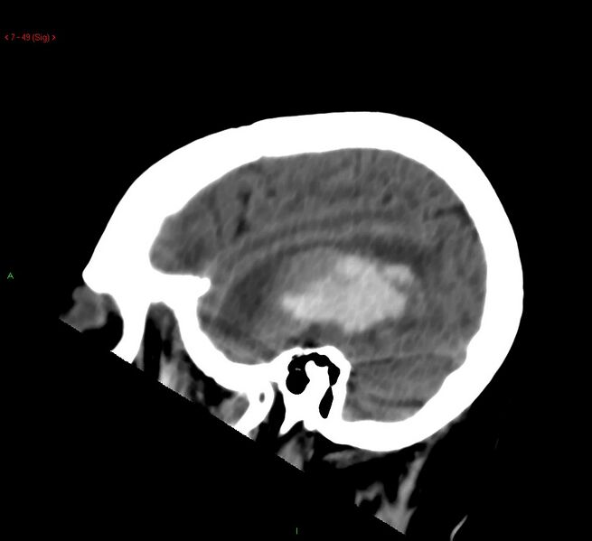 File:Cerebral amyloid angiopathy-associated lobar intracerebral hemorrhage (Radiopaedia 58378-65518 C 49).jpg