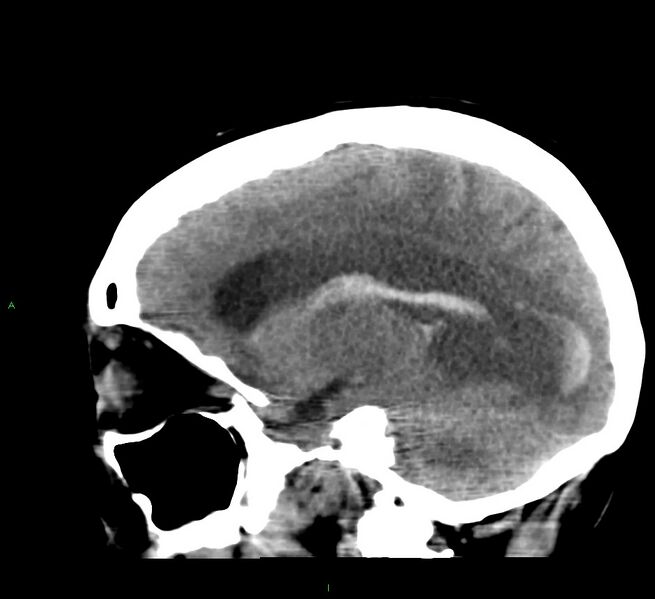 File:Cerebral amyloid angiopathy-associated lobar intracerebral hemorrhage (Radiopaedia 58379-65519 C 35).jpg