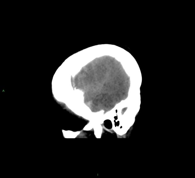 File:Cerebral amyloid angiopathy-associated lobar intracerebral hemorrhage (Radiopaedia 58561-65724 C 44).jpg
