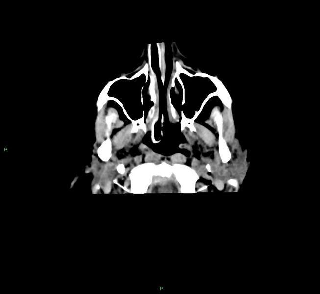 File:Cerebral amyloid angiopathy-associated lobar intracerebral hemorrhage (Radiopaedia 58751-65972 Axial non-contrast 48).jpg