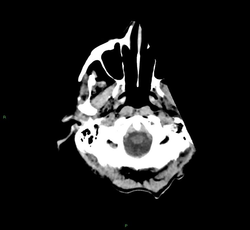 Cerebral amyloid angiopathy-associated lobar intracerebral hemorrhage (Radiopaedia 58758-65980 Axial non-contrast 46).jpg