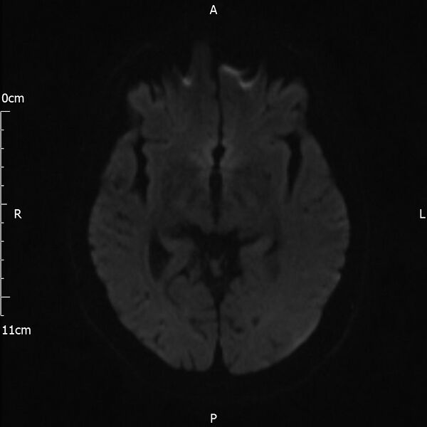 File:Cerebral amyloid angiopathy related inflammation (Radiopaedia 72772-83415 Axial DWI 57).jpg