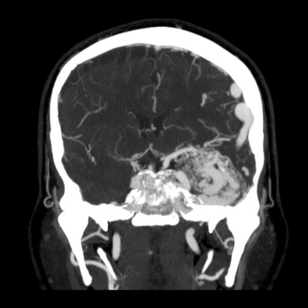 File:Cerebral arteriovenous malformation (Radiopaedia 43729-47189 C 21).jpg