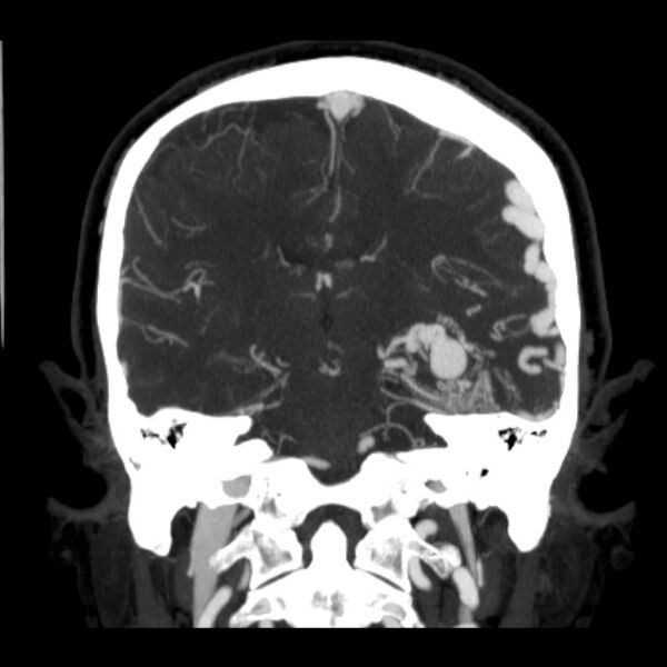 File:Cerebral arteriovenous malformation (Radiopaedia 43729-47189 C 27).jpg