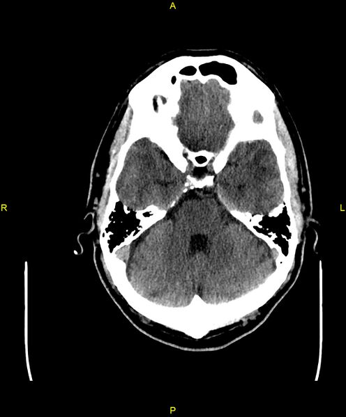 File:Cerebral autosomal dominant arteriopathy with subcortical infarcts and leukoencephalopathy (CADASIL) (Radiopaedia 86108-102051 Axial non-contrast 31).jpg