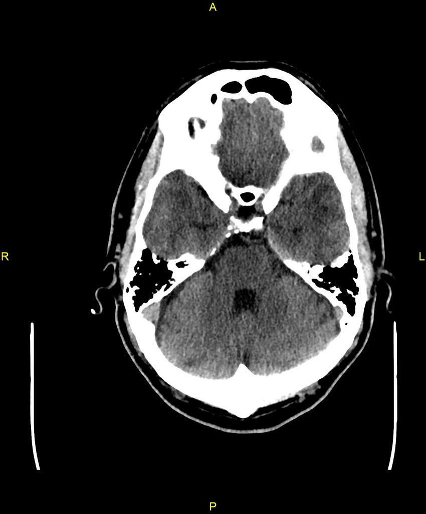Cerebral autosomal dominant arteriopathy with subcortical infarcts and leukoencephalopathy (CADASIL) (Radiopaedia 86108-102051 Axial non-contrast 31).jpg