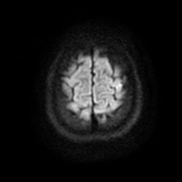 File:Cerebral cavernous malformation (Radiopaedia 44301-47942 Axial DWI 19).jpg