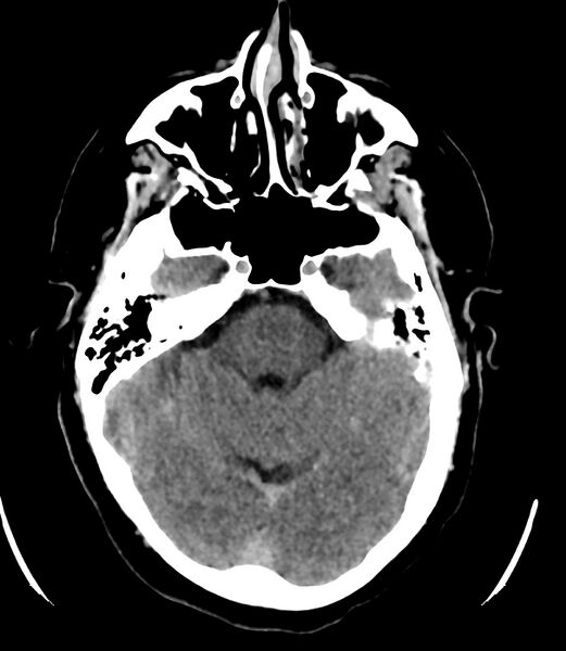 File:Cerebral dural venous sinus thrombosis (Radiopaedia 86514-102575 Axial non-contrast 14).jpg