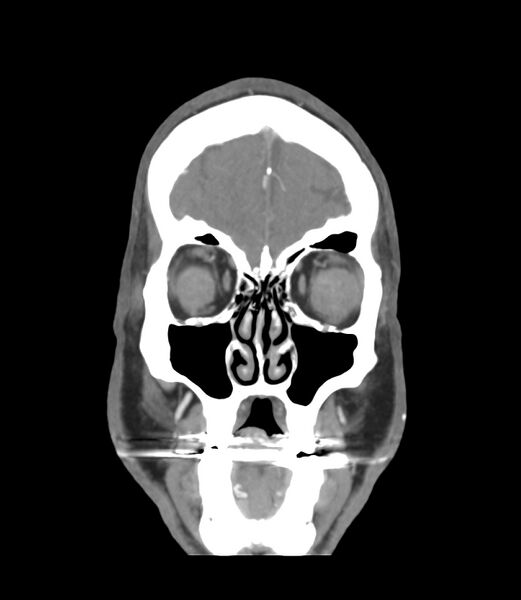 File:Cerebral dural venous sinus thrombosis (Radiopaedia 86514-102576 B 3).jpg