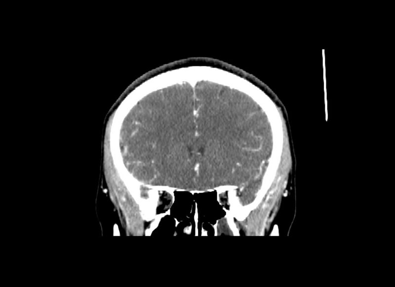 File:Cerebral edema (Radiopaedia 82519-96661 C 43).jpg