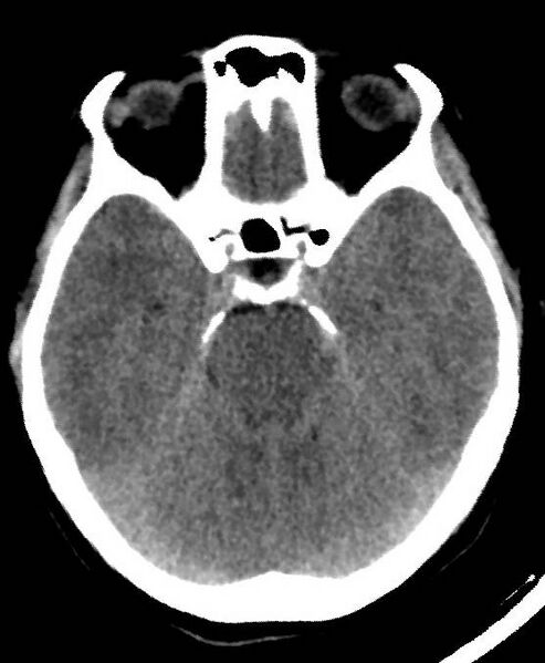 File:Cerebral edema due to severe hyponatremia (Radiopaedia 89826-106937 Axial non-contrast 30).jpg