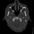 Cerebral hemorrhagic contusions (Radiopaedia 23145-23188 Axial bone window 1).jpg