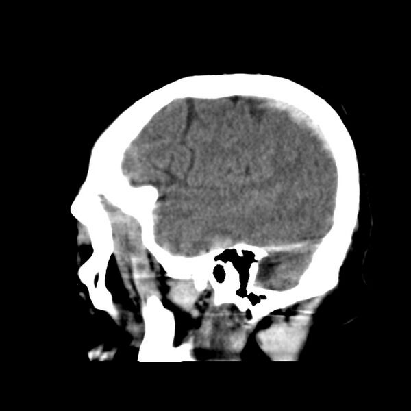File:Cerebral hemorrhagic contusions (Radiopaedia 23145-23188 C 9).jpg