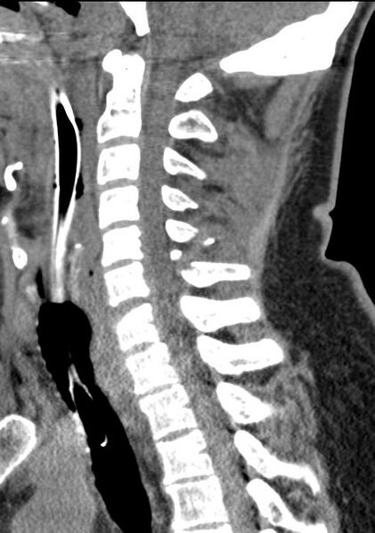File:Cerebral hemorrhagic contusions and cervical spine fractures (Radiopaedia 32865-33841 G 59).jpg