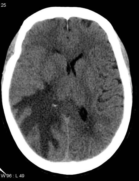 File:Cerebral metastasis - lung cancer (Radiopaedia 5315-7072 Axial non-contrast 4).jpg