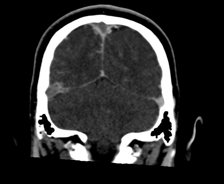 File:Cerebral venous sinus thrombosis (Radiopaedia 59224-66646 Coronal C+ delayed 61).jpg