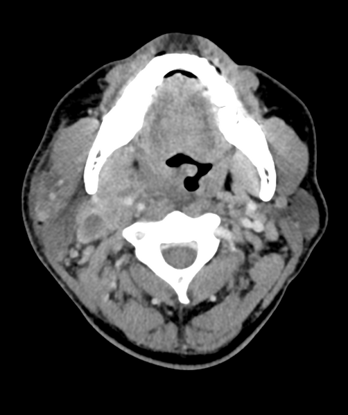 File:Cervical abscess (Radiopaedia 43725-47184 A 22).png