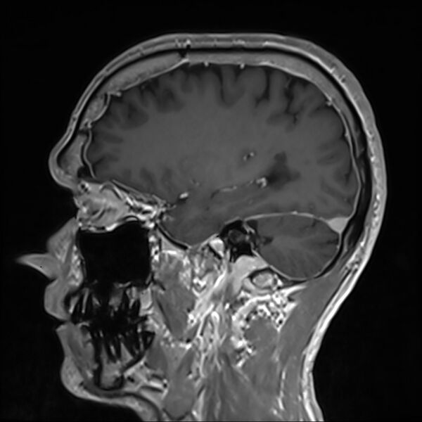 File:Cervical dural CSF leak on MRI and CT treated by blood patch (Radiopaedia 49748-54995 G 30).jpg