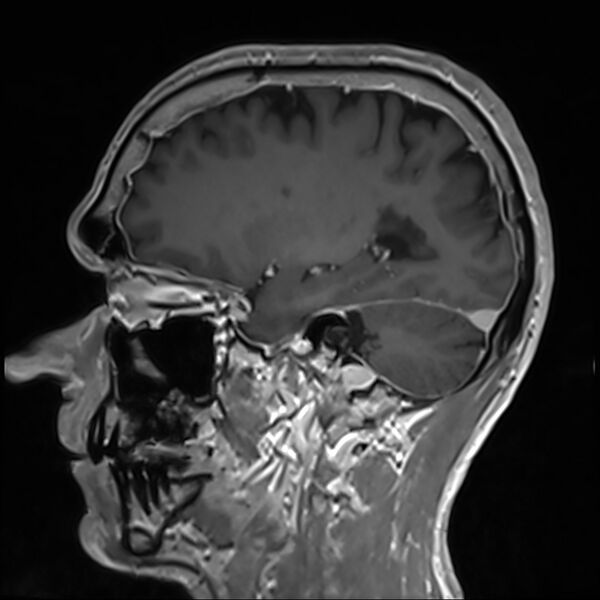 File:Cervical dural CSF leak on MRI and CT treated by blood patch (Radiopaedia 49748-54995 G 33).jpg