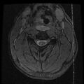 Cervical flexion teardrop fracture with cord hemorrhage (Radiopaedia 32497-33455 Axial Gradient Echo 10).jpg