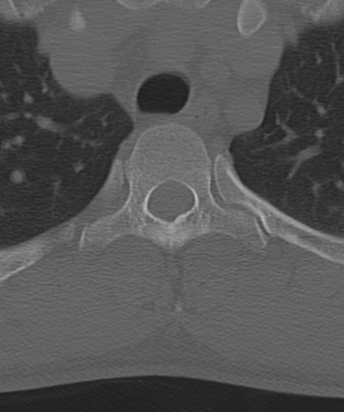 File:Cervical intercalary bone (Radiopaedia 35211-36748 Axial bone window 72).png
