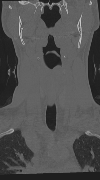 File:Cervical intercalary bone (Radiopaedia 35211-36748 Coronal bone window 19).png