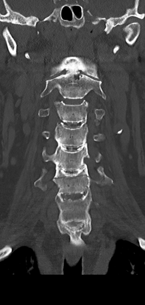 File:Cervical spine fracture - chalk stick (Radiopaedia 39116-41323 Coronal bone window 19).png