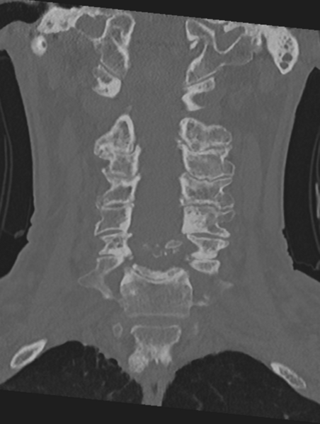 File:Cervical spondylolysis (Radiopaedia 49616-54811 Coronal bone window 24).png