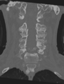 Cervical spondylolysis (Radiopaedia 49616-54811 Coronal bone window 24).png