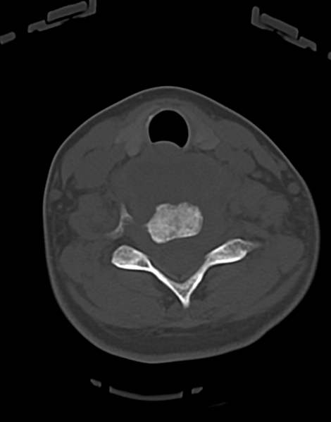 File:Cervical tuberculous spondylitis (Radiopaedia 39149-41365 Axial bone window 37).png