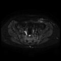 Cesarian section scar endometriosis (Radiopaedia 66520-75799 Axial DWI 31).jpg