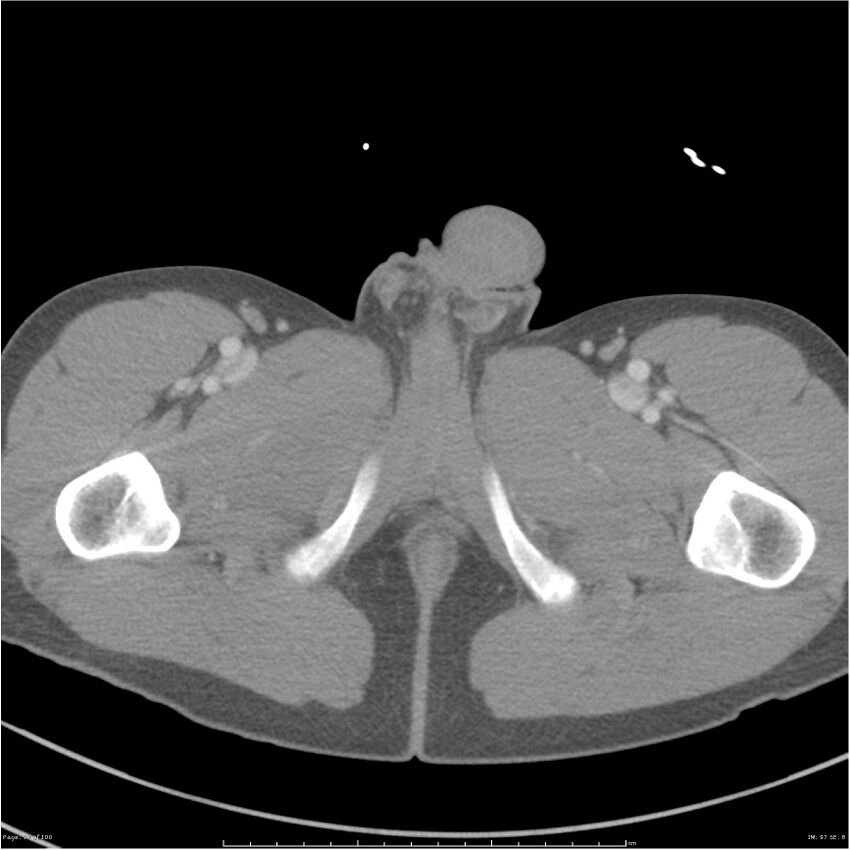 Chest and abdomen multi-trauma (Radiopaedia 26294-26426 A 97).jpg
