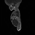 Chiari II malformation with spinal meningomyelocele (Radiopaedia 23550-23652 Sagittal T1 2).jpg