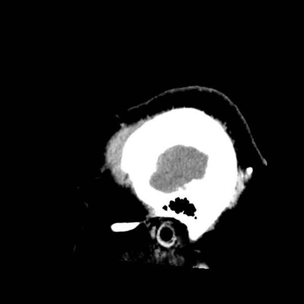 File:Chiasmatic-hypothalamic juvenile pilocytic astrocytoma (Radiopaedia 78533-91237 B 55).jpg