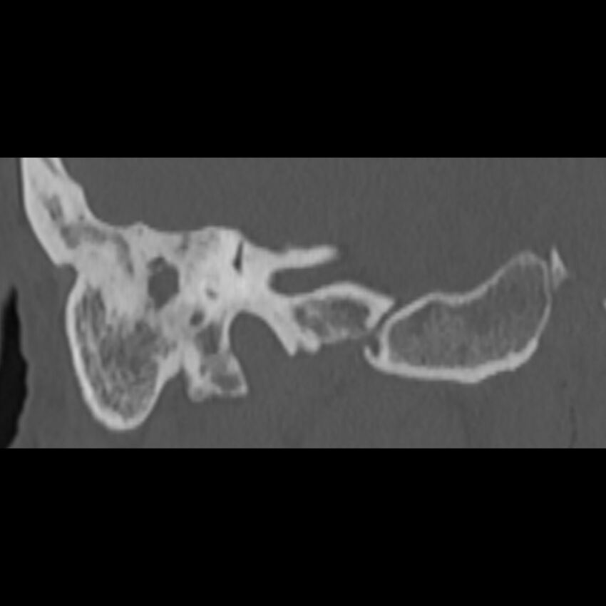 Cholesteatoma (Radiopaedia 68176-77673 Coronal bone window 55).jpg