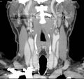 Chondrosarcoma - larynx (Radiopaedia 4588-6698 B 1).jpg