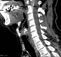 Chondrosarcoma - larynx (Radiopaedia 4588-6698 C 5).jpg
