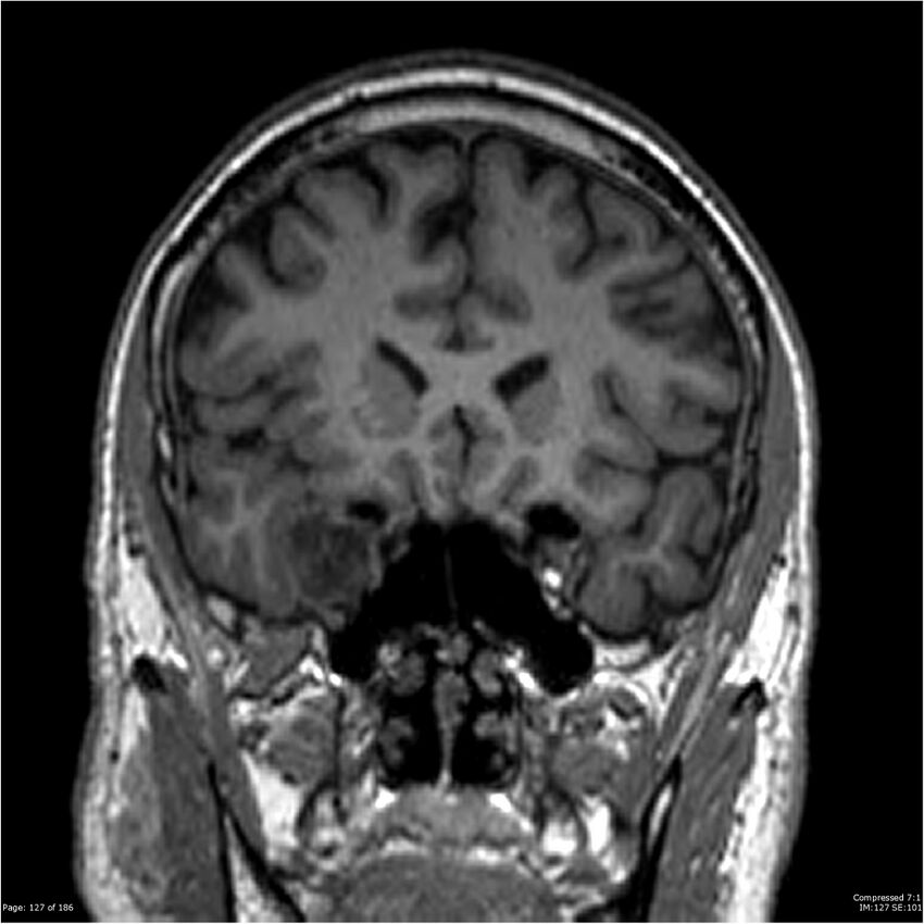 Chondrosarcoma of skull base- grade II (Radiopaedia 40948-43654 Coronal T1 48).jpg