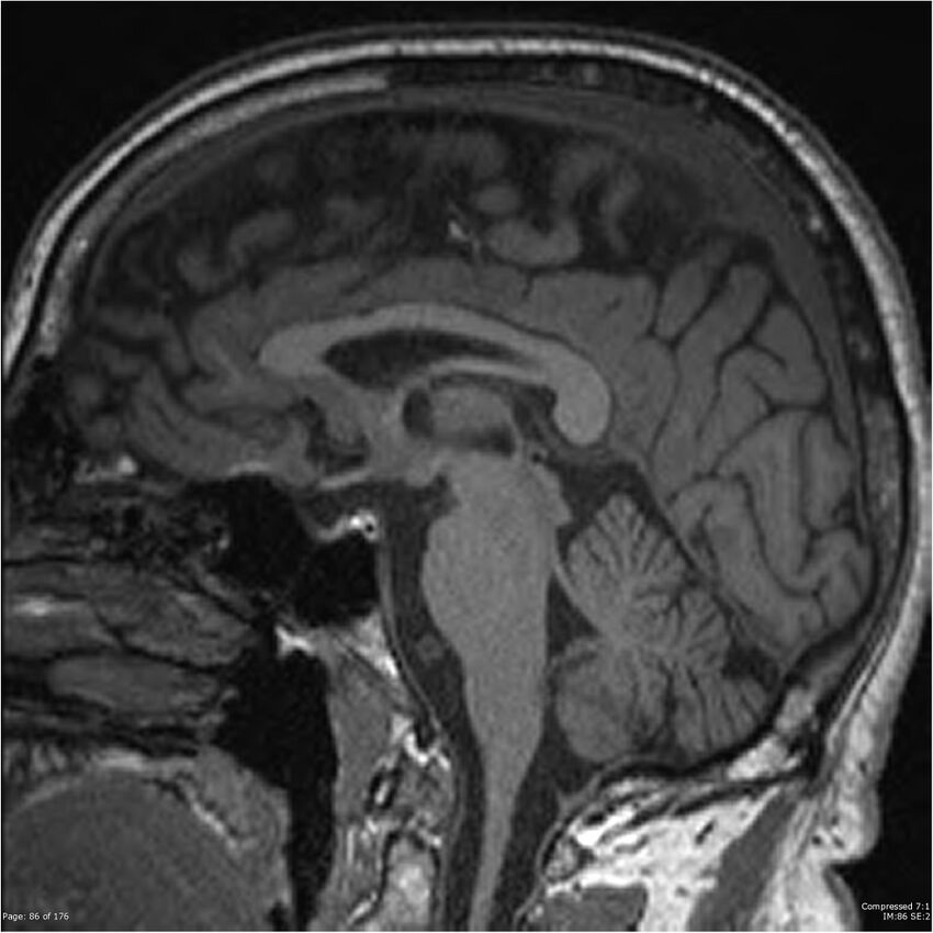 Chondrosarcoma of skull base- grade II (Radiopaedia 40948-43654 Sagittal T1 9).jpg