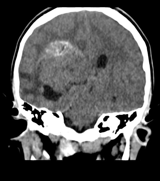 File:Choroid plexus carcinoma (Radiopaedia 91013-108552 Coronal non-contrast 48).jpg