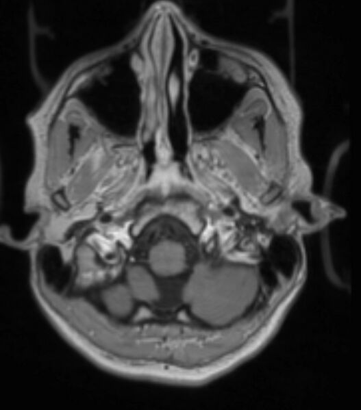 File:Choroid plexus carcinoma (Radiopaedia 91013-108553 Axial T1 C+ 81).jpg