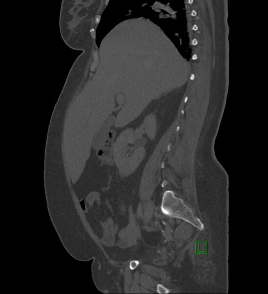 File:Chromophobe renal cell carcinoma (Radiopaedia 84239-99519 Sagittal bone window 70).jpg