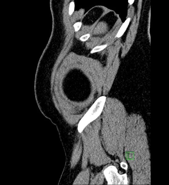 File:Chromophobe renal cell carcinoma (Radiopaedia 84286-99573 C 3).jpg