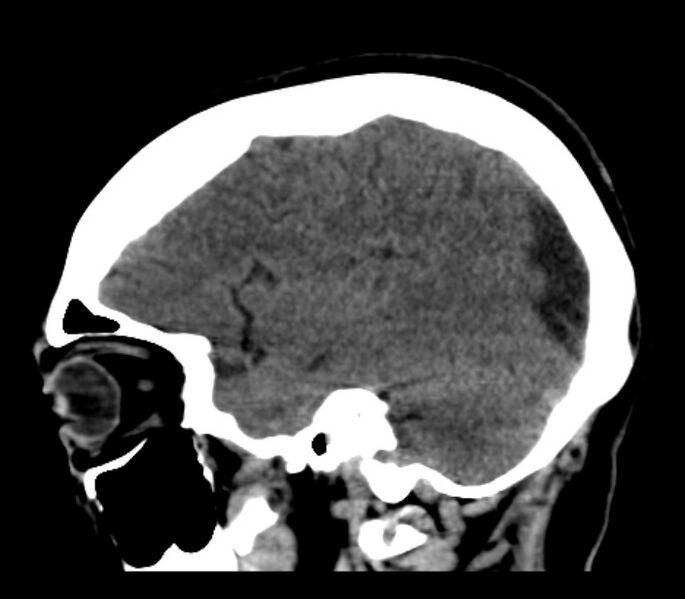 File:Chronic bilateral occipital lobe infarcts (Radiopaedia 31276-31996 C 29).jpg