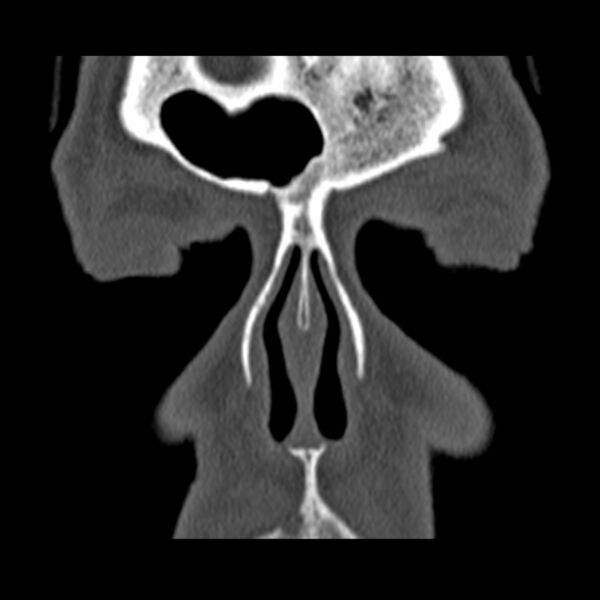 File:Chronic maxillary sinusitis (Radiopaedia 27879-28116 Coronal bone window 7).jpg