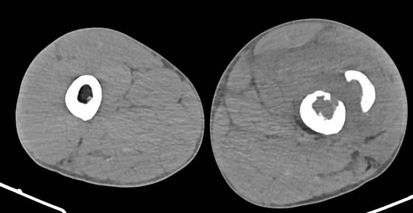 Chronic osteomyelitis (with sequestrum) (Radiopaedia 74813-85822 D 88).jpg