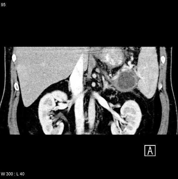 File:Chronic pancreatitis and pseudocysts (Radiopaedia 6724-7935 C 11).jpg
