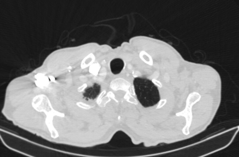 File:Chronic pulmonary embolism (Radiopaedia 91241-108843 Axial lung window 3).jpg